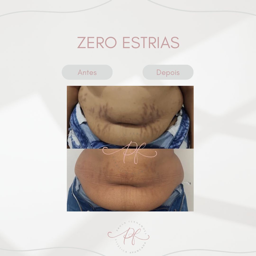 zero-estrias (1) zero-estrias (1)