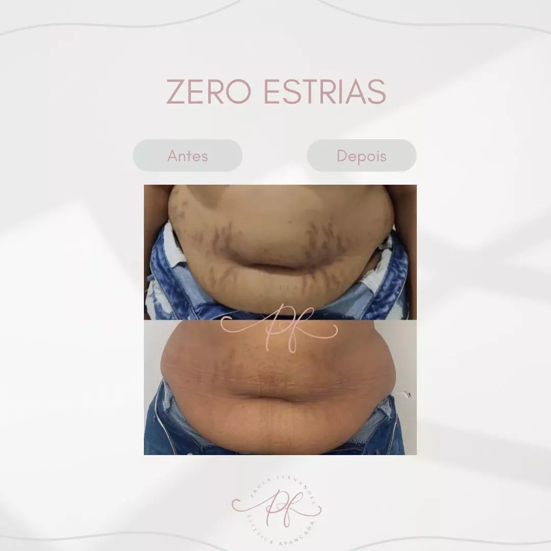zero-estrias (1) zero-estrias (1)